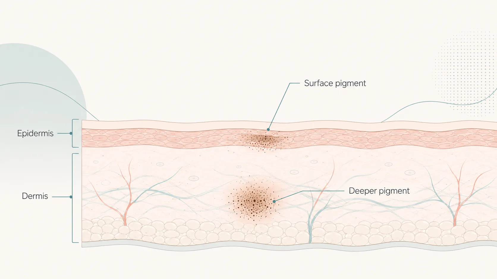 Cross-section of skin showing surface pigment sitting in the epidermis and deeper pigment in the dermis, with the layers labelled.