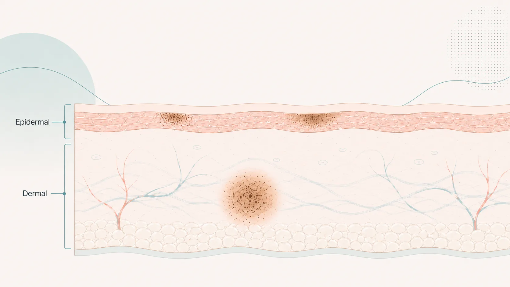 Cross-section of skin showing epidermal pigment near the surface and deeper dermal pigment, with the layers labelled.